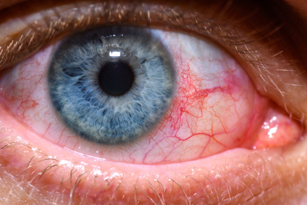 Czerwone Oczy Przyczyny Leczenie Porady Lekarskie Recepty Zwolnienia I Konsultacje Online 0722